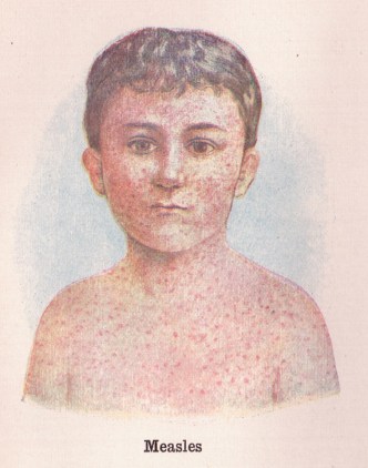 Measles illustration from The Practical Guide to Health by Frederick M. Rossiter, 1908, public domain via Wikimedia Commons